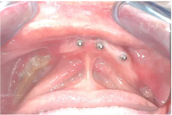 Figura 17 – Osteomielite da mandíbula com drenagem (imagem cedida pelo Prof. Doutor Francisco  Salvado) 