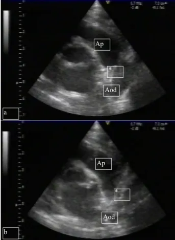 Fig. 2 – Ecocardiograma com Doppler a cores do Canal Arterial. 