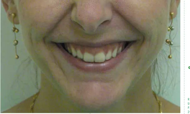 Figura 1: Exposição acentuada da gengiva, caracterizando o sorriso gengival.