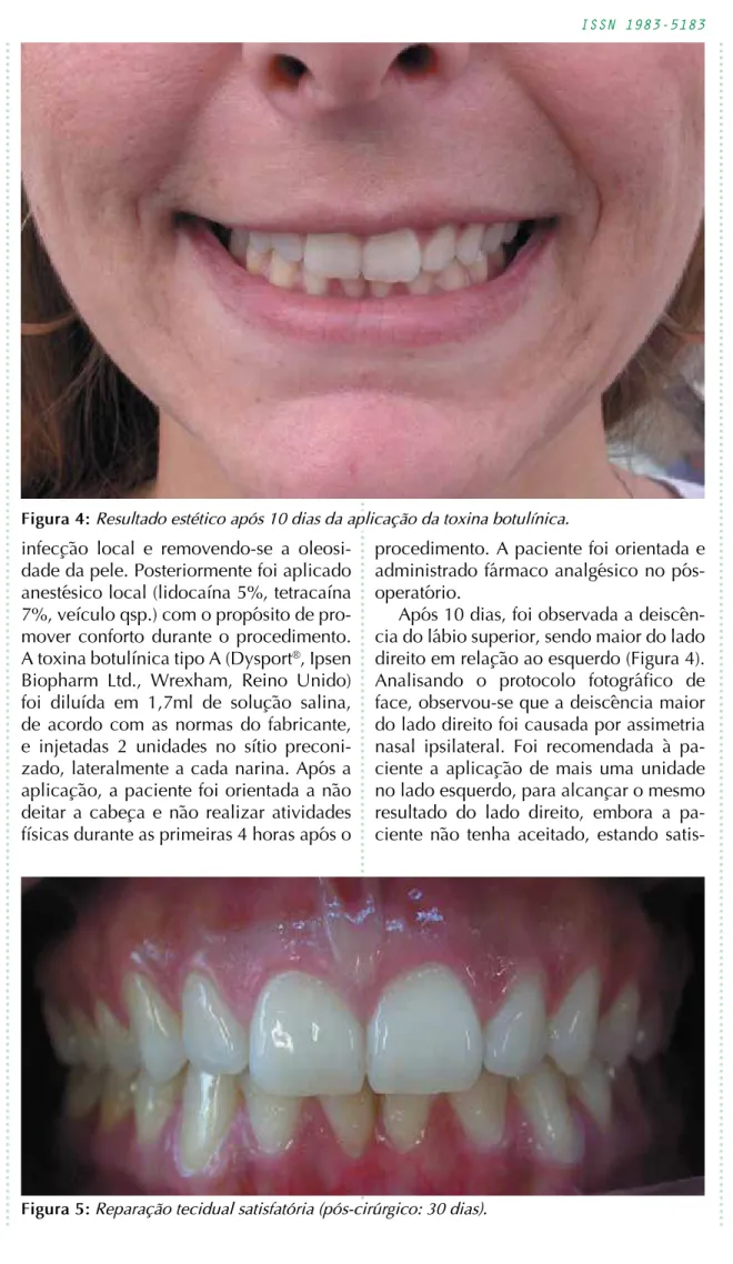 Figura 5: Reparação tecidual satisfatória (pós-cirúrgico: 30 dias).