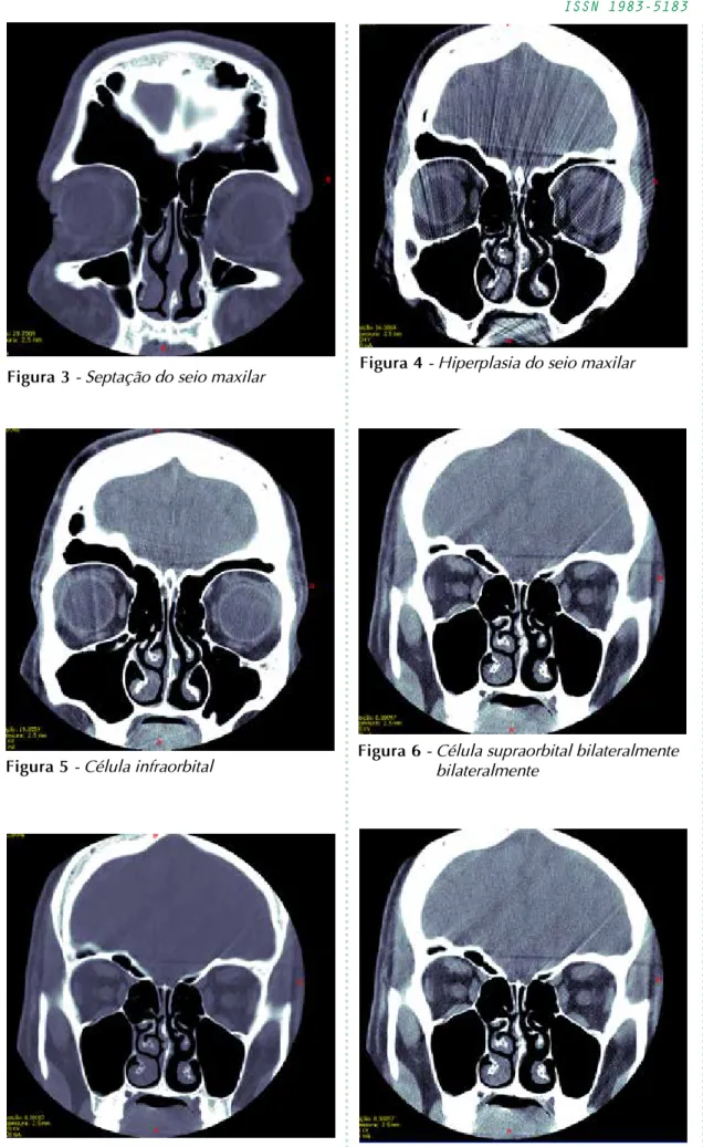Figura 3 - Septação do seio maxilar Figura 4 - Hiperplasia do seio maxilar