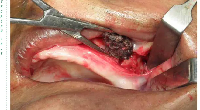 Figure 3 –   Fragmentation of the calcified foreign body, 2.4 cm in diameter, revealing the pres- pres-ence of a residual root within the calcification