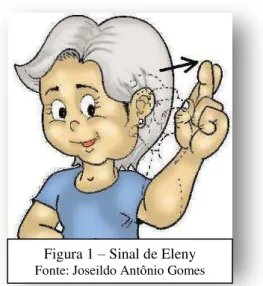 Figura 1  – Sinal de Eleny 