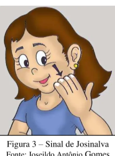 Figura 3 – Sinal de Josinalva 