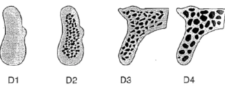 Figura  7.  Misch (1988). D1  –  Osso cortical  denso; D2  –  Osso cortical  denso poroso e osso trabecular  denso; D3 – Osso cortical fino poroso e osso trabecular fino; D4 – Osso cortical praticamente inexistente  e osso trabecular fino ocupa quase todo 