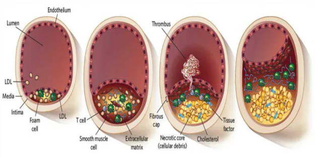 Figure 1 - Evolution of atherosclerosis. Image obtained from Rader et al [6]. 