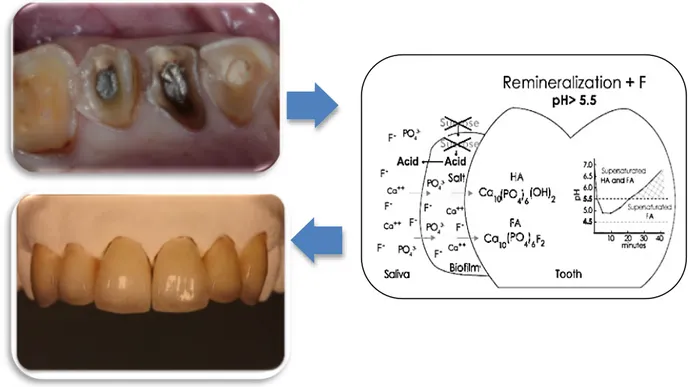 Figura 1- Abordagem terapêutica da erosão dentária (Adaptado de Colon &amp; Lussi, 2014; Magne &amp; 