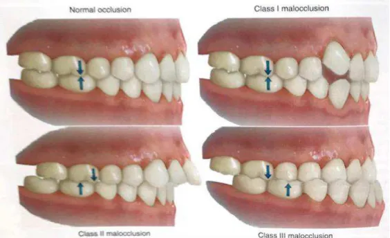 Figura 7: Posicionamento dos primeiros molares permanentes nos diferentes tipos de classe  (adaptado de Graber, Vanaesdall Jr., Vig, &amp; Huang, 2017) 