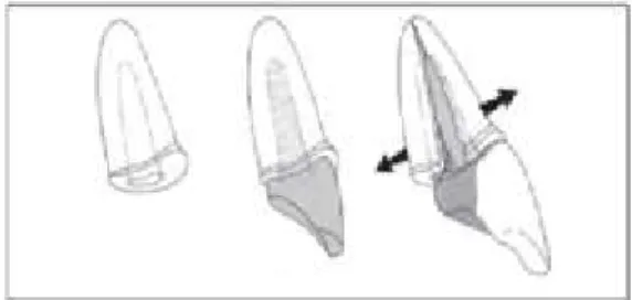 Figura 6 - Dente anterior com pouca altura coronária. Quando reabilitado com poste levou à fratura  radicular