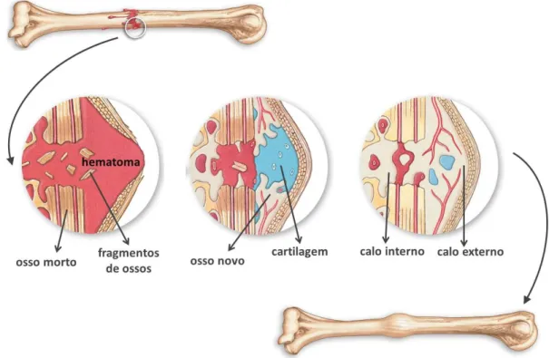 Figura 2.5  Ilustração das etapas de reparação óssea. Adaptado de Martini e  colaboradores [32]