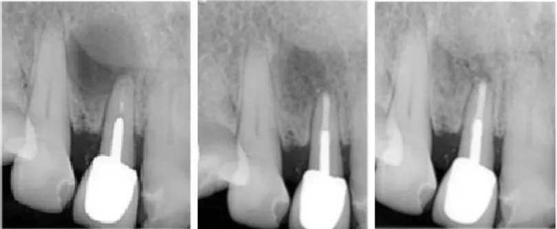 Figura 4- Radiografia pré-operatória, pós-operatória imediata e com 1 ano de follow up (Adaptado de  Debelian et al., 2016) 