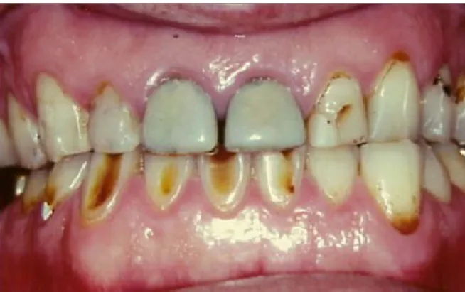 Figura 1- Superfícies vestibulares de paciente com  estado avançado de erosão dentária (Branco et al., 