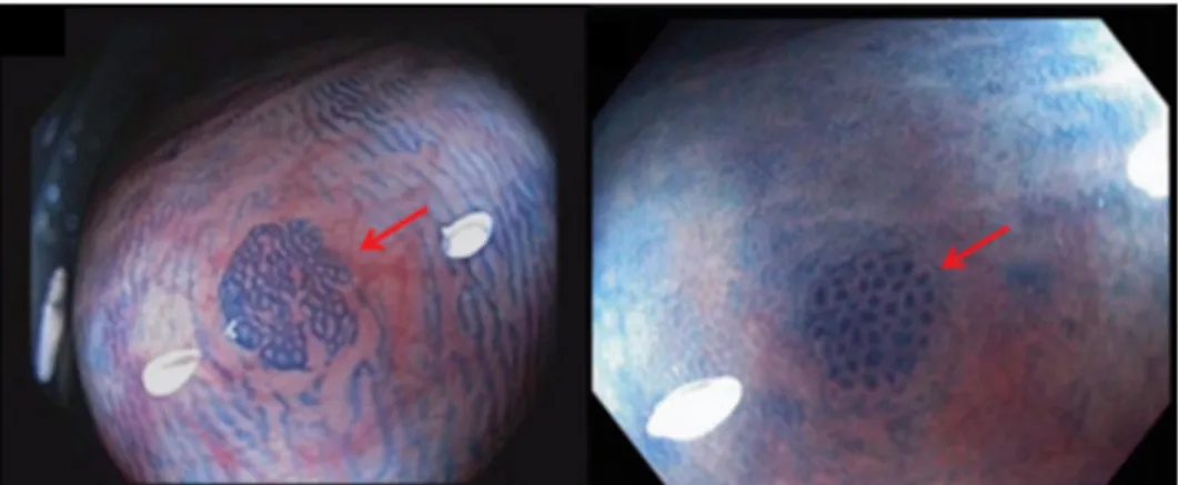 Figura  4  -  Focos  de  criptas  aberrantes.  Na  imagem  estão  representadas  imagens  endoscópicas de mucosa de cólon corada com azul-de-metileno onde se observam alterações  denominadas por focos de criptas aberrantes (indicadas pelas setas)