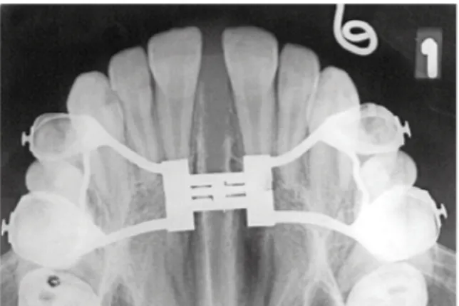 FIGURA 2:  Imagem  digitalizada  da  sutura  palatina  mediana após seu rompimento