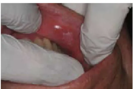 Figura 1 - Imagem de uma leucoplasia, em lábio.