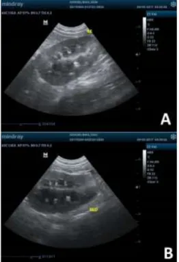 Figura 2: Exame ecográfico renal pré (A) e pós  cirúrgico (B)  