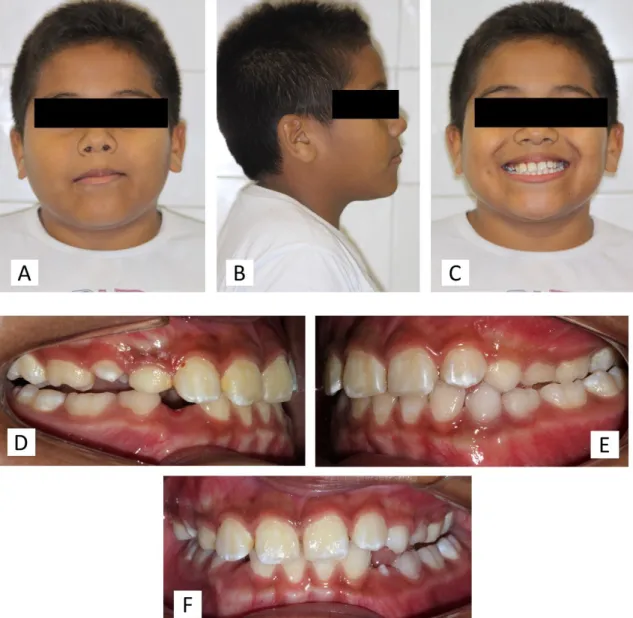 Figura 8 (A-H) Instalação do aparelho removível progênico – A) frente, B) perfil, C)   sorrindo,   D)   oclusão   lado   direito,   E)   oclusão   lado   esquerdo,   F)   oclusão frontal, G) vista oclusal do arco superior e H) vista oclusal do arco inferio