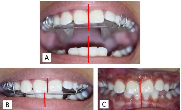 Figura   10   (A-C)   Adaptação   com   aletas   de   resina   acrílica   –   A)   detalhe   das haletas   de   resina   na   placa   de   acrílico   do   palato,   B)   oclusão   com   aparelho comparando   as   linhas   médias   e   C)   oclusão   sem   
