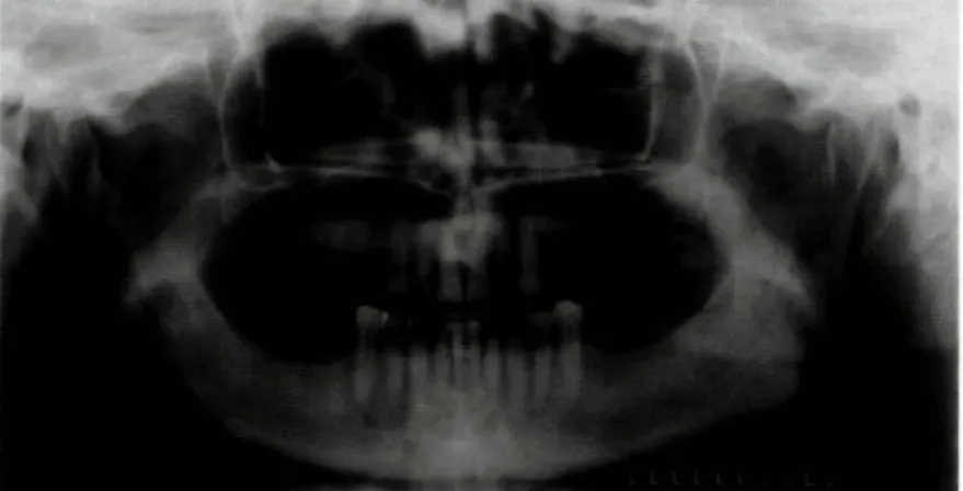 Figura 1 - Ortopantomografia inicial. 
