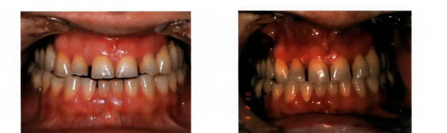 Figura 8 - Próteses em boca. Notar  espaço interoclusal anterior. 