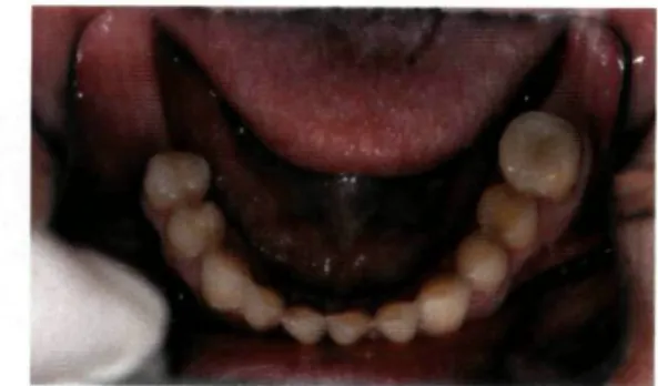 Figura 7 - Arcada maxilar após  cimentação dos encaixes  supra-radicu lares e preparação justagengival  dos restantes dentes
