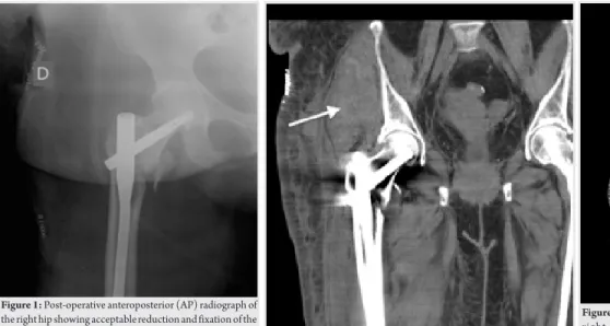 Figure  2:  Computed tomography  (CT)scan of  the  right hip  revealed  extensive hematoma (arrow).Post-operative day 5 CT scan of pelvis and  right hip revealed an extensive hematoma in the region of the gluteus  medius measuring 25 cm × 7cm (arrow).