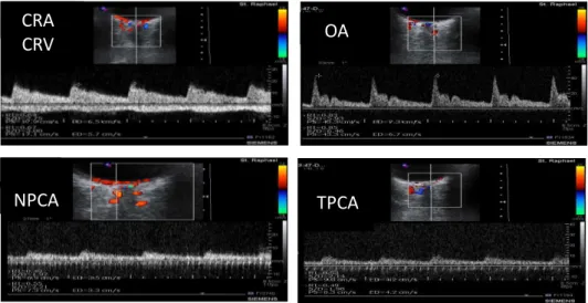 Figure  1.  Example  from  a  patients’  CDI  examination  of  the  retrobulbar  vessels:  central  retinal  artery  and  vein  (CRA,  CRV;  respectively),  ophthalmic  artery  (OA),  nasal  and  temporal  posterior  ciliary  arteries  (NPCA,  TPCA;  respe