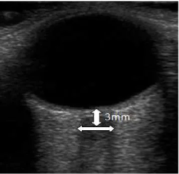 Figure 3. Optic nerve sonography. The optic nerve complex is shown as a sharply-defined  hypoechoic stripe in between the echogenic retrobulbar fat 