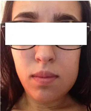 Figure 3: Postoperative swelling visible in  the left side of the face of the patient after 3.8 