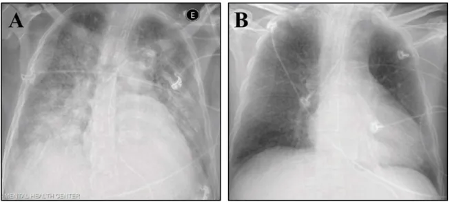 Figura 4. Radiografia de paciente diagnosticado com aids/histoplasmose.  