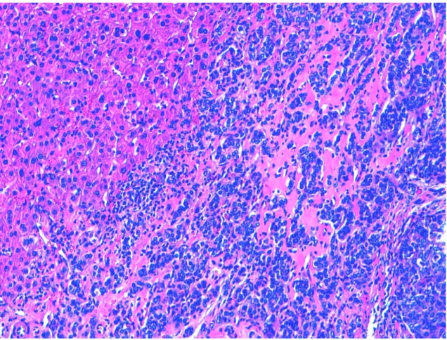 Figura 4. Imagem histológica de metástase hepática de carcinoma tímico. À esquerda da imagem, observa-se tecido hepático  normal e, à direita, evidencia-se uma infiltração pelo tumor (H&amp;E 100x)