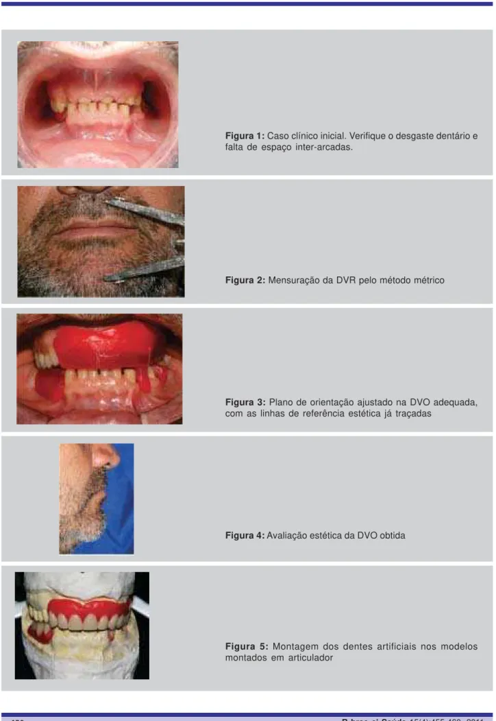 Figura 1: Caso clínico inicial. Verifique o desgaste dentário e
