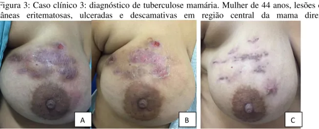 Figura 3: Caso clínico 3: diagnóstico de tuberculose mamária. Mulher de 44 anos, lesões cu- cu-tâneas  eritematosas,  ulceradas  e  descamativas  em  região  central  da  mama  direita