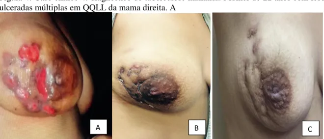 Figura 4: Caso clínico 4: diagnóstico de tuberculose mamária. Mulher de 22 anos com lesões  ulceradas múltiplas em QQLL da mama direita