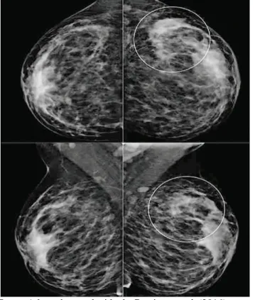 Figura 6: Imagem de mamografia na mastite granulomatosa. Evidência de mamas heterogene- heterogene-amente densas e assimetria focal em QSL da mama esquerda