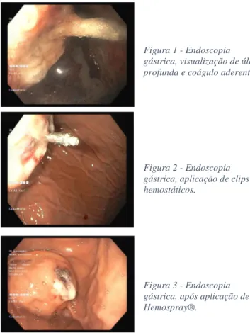 Figura 1 - Endoscopia  gástrica, visualização de úlcera  profunda e coágulo aderente.