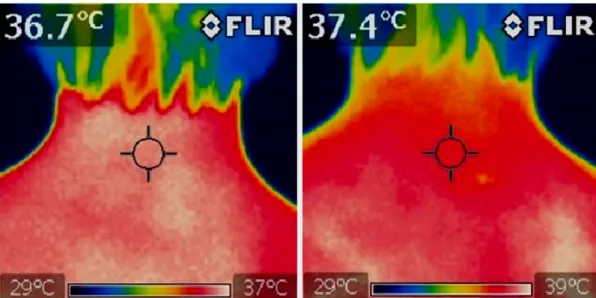 Figura 1. Termogramas da coluna cervical mostrando as variações no calor radiante (infravermelho)  que deixam à superfície corpórea antes e após a aplicação da diatermia por ondas curtas