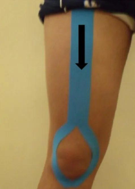 Figura  1:  Ativação do músculo  quadríceps. Técnica em  &#34;Y&#34;aplicada da  região  abaixo da  espinha  ilíaca  antero-  superior  até  o  tendão  patelar  com  tensão  da  fita  de  cima  para  baixo de 20%