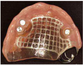 Figure 5. Clinical view of the new dentures 