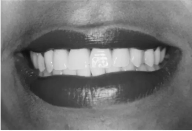 Figure 8 Frontal view of the patient showing the favorable esthetic