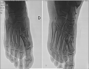 Figura 4 - Fratura do 1º metatarso do pé direito após traumatismo  com os pedais por acidente de viação