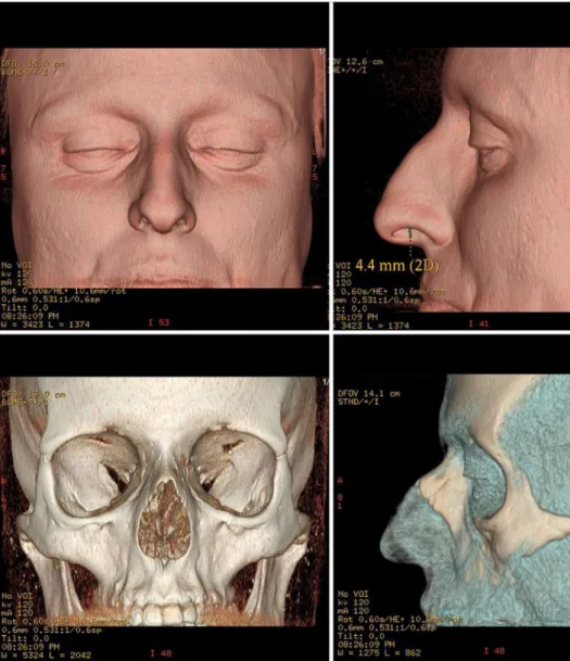 Fig. 1    Three-dimensional CT  scan facial reconstructions