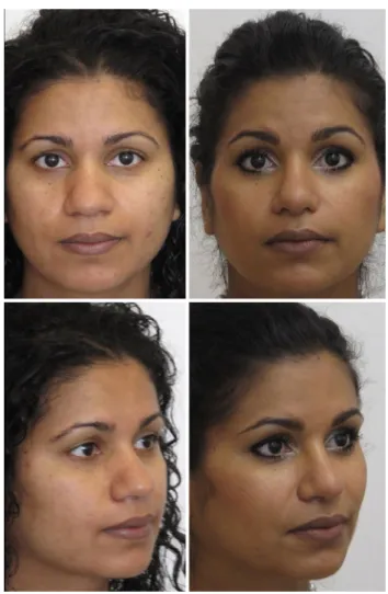 Fig. 6   Preoperative (left) and postoperative (right; 1  year post-sur- post-sur-gery) clinical images—patient 3