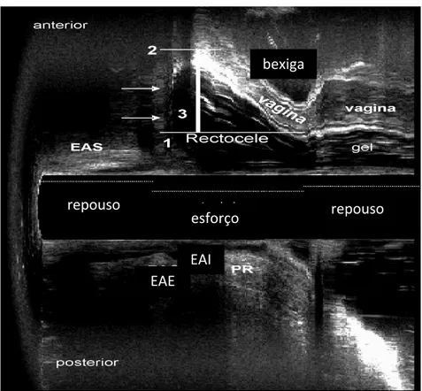 Figura 2  –  Ecodefecografia demonstrando retocele (Paciente número 4) 