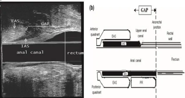 FIGURA 3 – a) Imagem ultrassonográfica longitudinal do canal anal feminino normal e junção anorretal