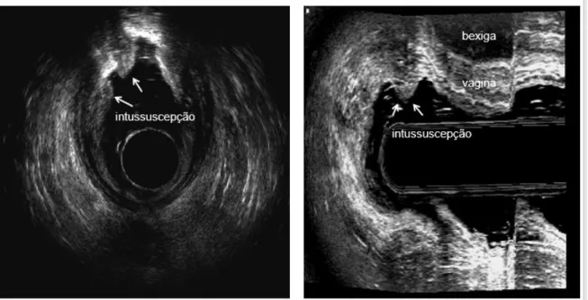 Figura 5 – Imagem ultrassonográfica de retocele gr III (paciente 64) 