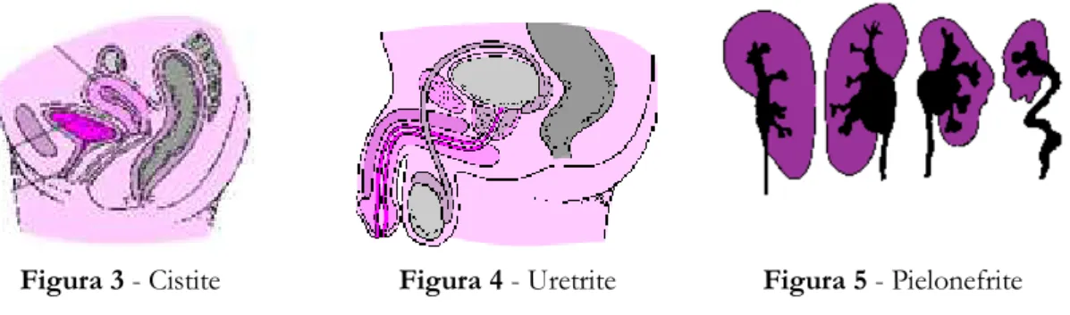 Figura 3 - Cistite  Figura 4 - Uretrite  Figura 5 - Pielonefrite 