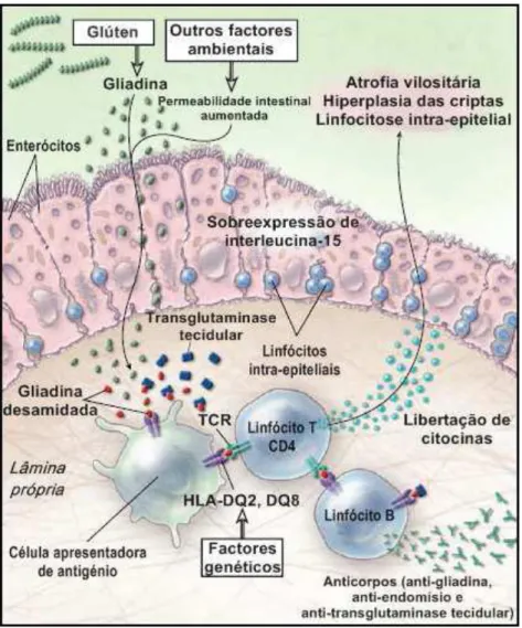 Figura 3 - Interacção entre factores ambientais, genéticos e imunológicos na patogénese de  doença celíaca (Green [31], Adaptado por Samões [32])