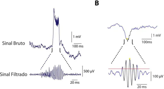 Figura 5  – Exemplos de oscilações de alta frequência patológicas observadas no hipocampo  de  um  animal  cronicamente  epiléptico  (modelo  experimental)  e  no  córtex  cerebral  de  um  paciente  com  epilepsia  do  lobo  temporal  sem  esclerose  hipp