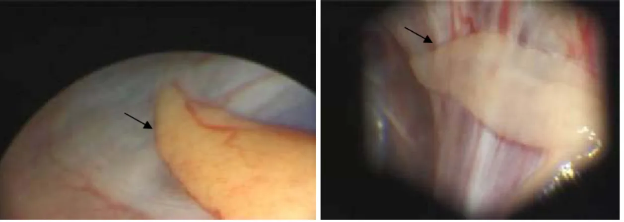 Fig. 9 Photos of male gonads under laparoscopic observation: testis (arrows) can vary from bright yellow to pale  white, sometimes showing a capillary web (left); testis are usually fusiform in shape, but note the folded testis on the  right picture (right